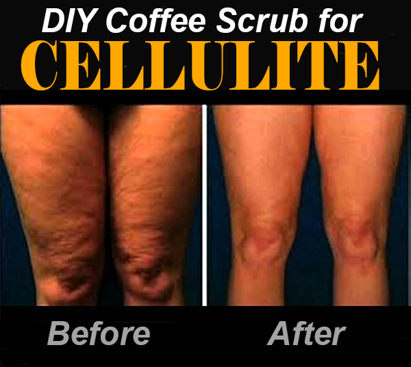 cellulite cup reviews before and after