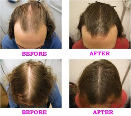 cvs hair regrowth treatment reviews